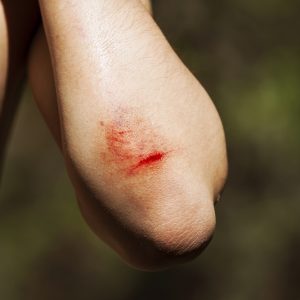 טיפול בחתכים בידיים