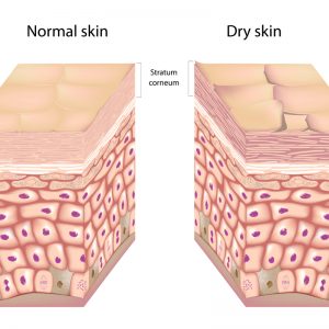 טיפול בעור יבש