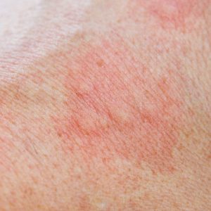 טיפול באודם בעור