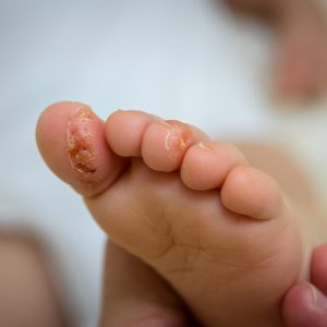 טיפול באקזמה