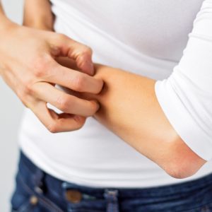 טיפול באקזמה