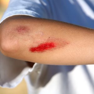 טיפול בחתכים בידיים