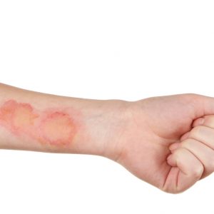 טיפול בכוויות