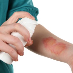 טיפול בכוויות