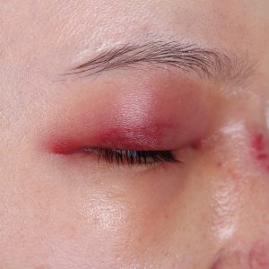 טיפול בנפיחות