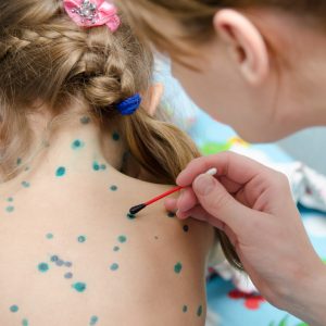 טיפול באבעבועות רוח