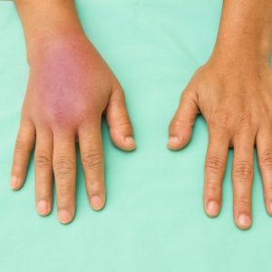 טיפול בנפיחות