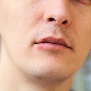 טיפול בהרפס