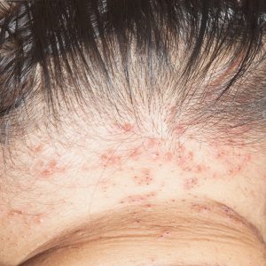 טיפול בסבוריאה בראש