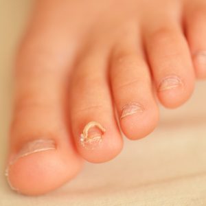 טיפול בפטריות בציפורניים