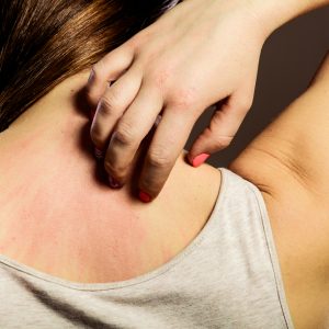 טיפול בגרד בעור