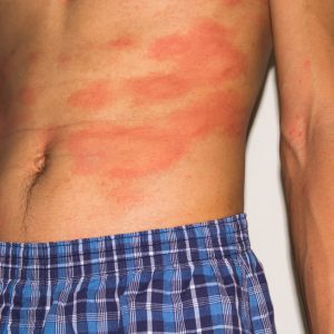 טיפול באקזמה