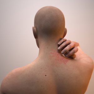 טיפול בסבוריאה בראש