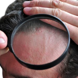 טיפול בסבוריאה בראש