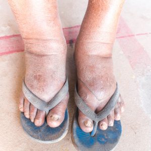 טיפול בנפיחות