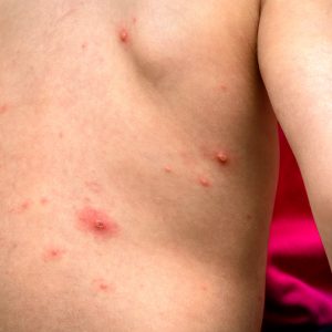 טיפול באבעבועות רוח