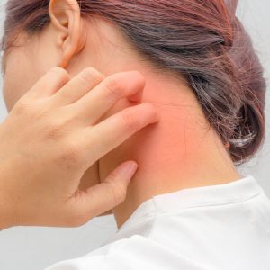 טיפול באודם בעור