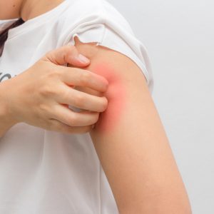 טיפול בגרד בעור