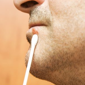 טיפול בהרפס