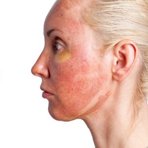 טיפול בכוויות